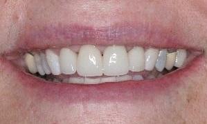 Cosmetic-Dentistry-After-Image