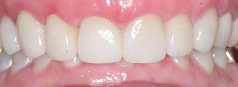 Cosmetic-Dentistry-After-Image