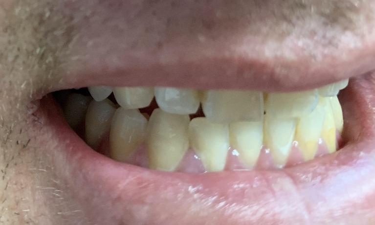 ICON-Resin-Infiltration-Treatment-After-Image