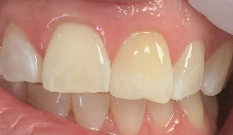 ICON-Resin-Infiltration-Treatment-After-Image