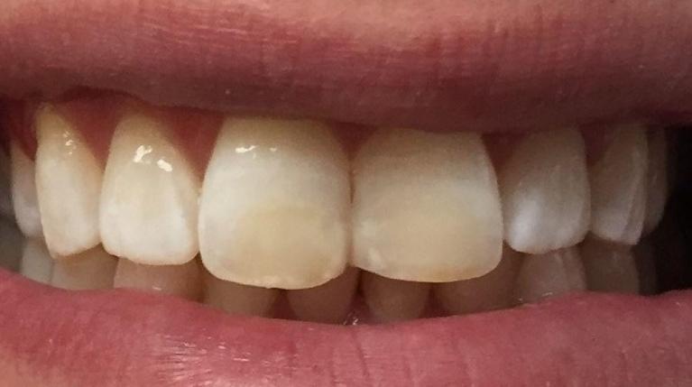In-Office-Whitening-and-Fillings-After-Image