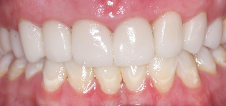 Porcelain-Crowns-and-Scaling-Root-Planing-After-Image