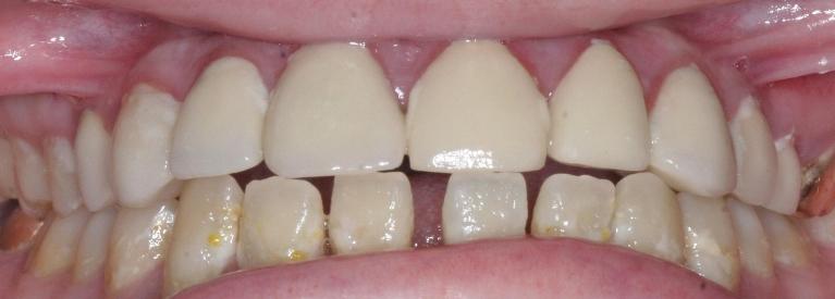 Porcelain-Crowns-After-Image