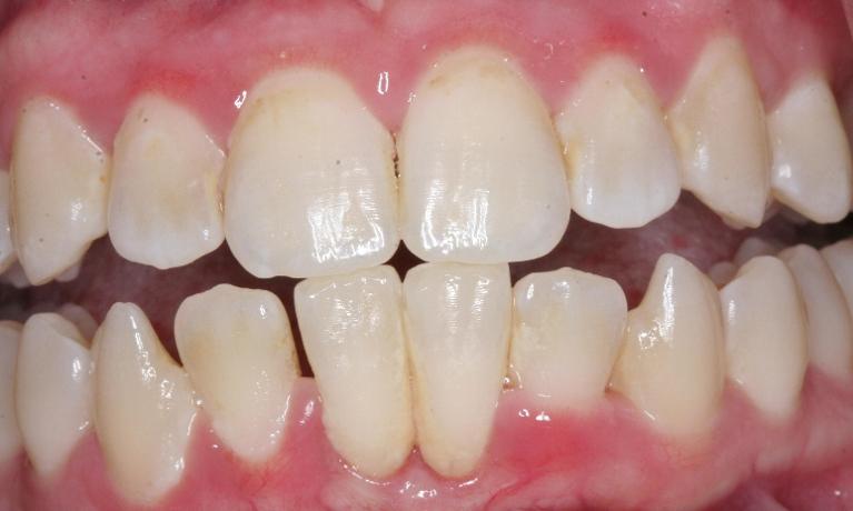 Scaling-and-Root-Planing-After-Image