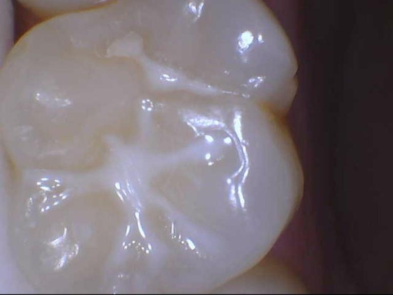 Sealants-After-Image