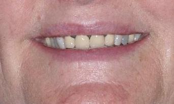 Cosmetic-Dentistry-Before-Image