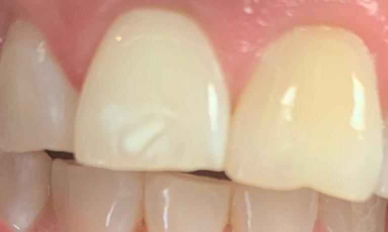ICON-Resin-Infiltration-Treatment-Before-Image