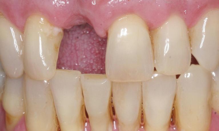 Porcelain-Bridge-Before-Image