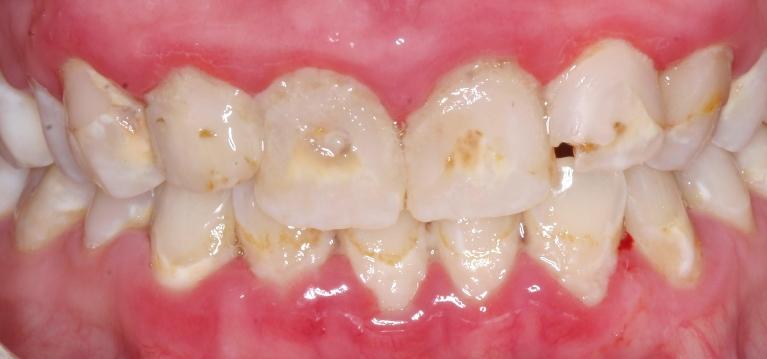 Porcelain-Crowns-and-Scaling-Root-Planing-Before-Image