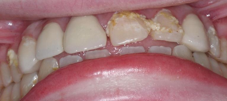 Porcelain-Crowns-Before-Image
