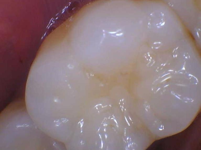 Sealants-Before-Image